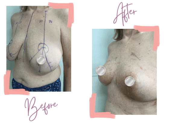 Tracy Surgery Before & After - Breast Reduction - Medi Makeovers