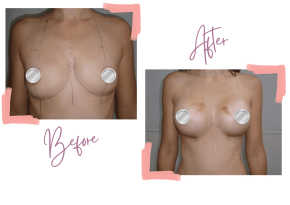 Breast Augmentation. Mentor 375cc Smooth Round High Profile - Jessie
