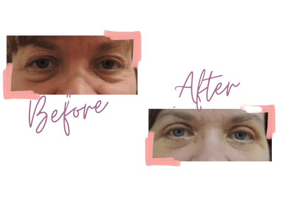 Upper and lower eyelid lift - Medi Makeovers - Cosmetic Surgery