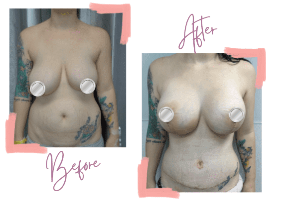 Katherine - Breast Augmentation, Breast lift, Tummy tuck, and Liposuction - Mummy Makeover - Medi Makeovers - Cosmetic Surgery