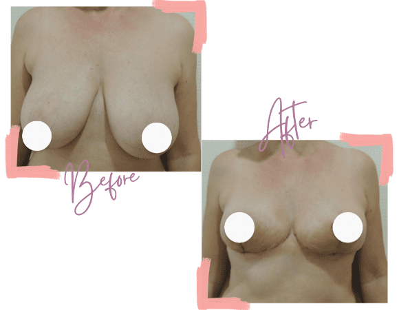 Kim Before and After Breast Reduction - Medi Makeovers