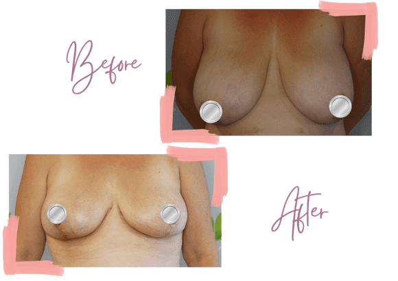 Lindsey Surgery Before & After Breast Reduction - Medi Makeovers