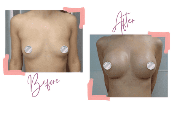 Breast Augmentation - Medi Makeovers - Cosmetic Surgery