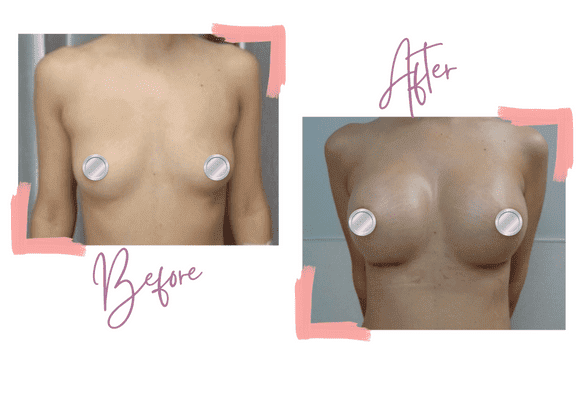 Boob Implants Australia - Breast Augmentation Australia & Thailand