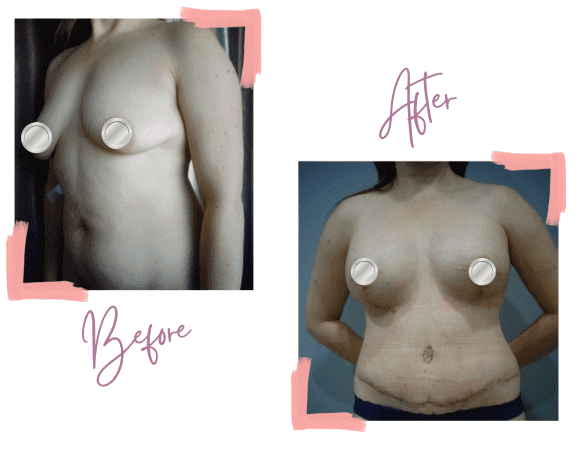 Breast lift, Breast Implants, and Tummy Tuck - Mummy Makeover - Medi Makeovers - Cosmetic Surgery