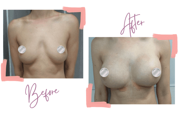 Breast Implants. Mentor 375cc Smooth Round High Profile - Michelle