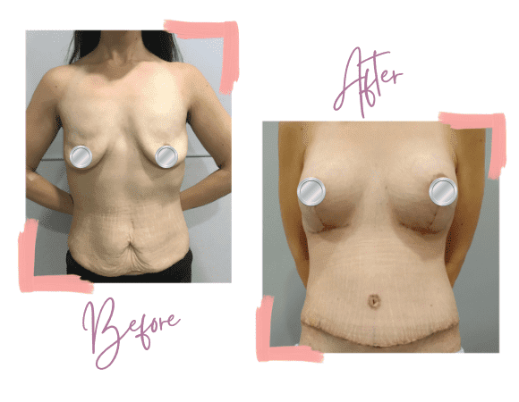 Susan - Breast lift, Breast Implants, and Extended Tummy Tuck - Mummy Makeover - Medi Makeovers - Cosmetic Surgery