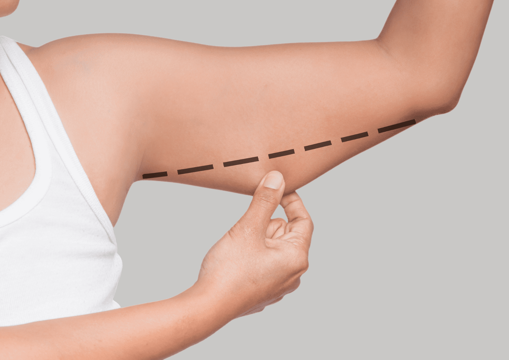 Invisible Arm Lift Surgery Australia Arm Lift Surgery Australia Arm