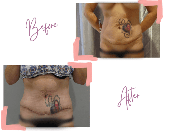 Vanessa - Tummy Tuck - Cosmetic Surgery - Medi Makeovers