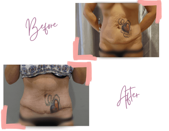 Vanessa Surgery Before & After