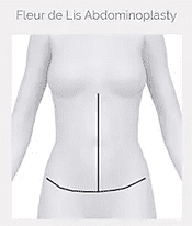 Extended Tummy Tuck