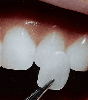 Veneers - Dental - Medi Makeovers