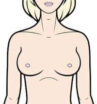 Breast Procedures - Front - Medi Makeovers