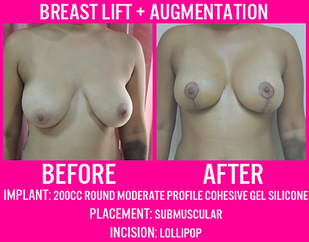 200CC Round High Profile Submuscular - Breast Lift - Medi Makeovers