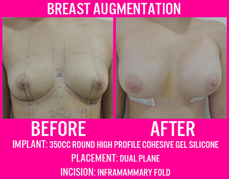 350CC Round High Profile - Breast Augmentation - Medi Makeovers
