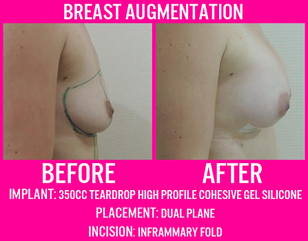 350CC Teardrop High Profile - Breast Augmentation - Medi Makeovers