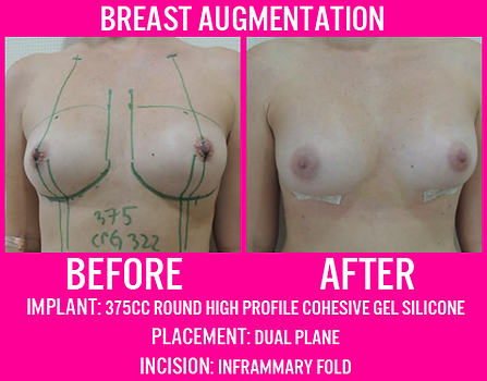 375CC Round High Profile Gel - Breast Augmentation - Medi Makeovers