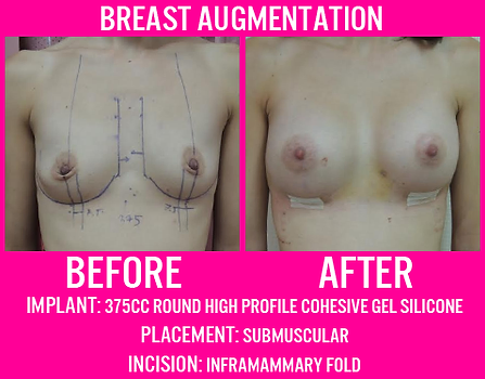 375CC Round High Profile Gel - Breast Augmentation - Medi Makeovers