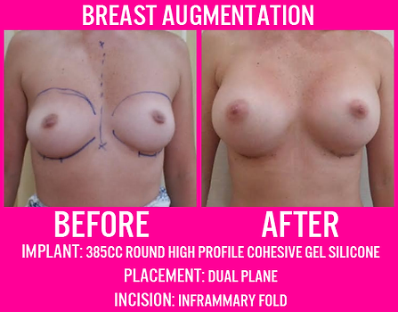 385CC High Profile Gel - Breast Augmentation - Medi Makeovers