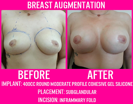 400 Round Moderate Profile - Breast Augmentation - Medi Makeovers