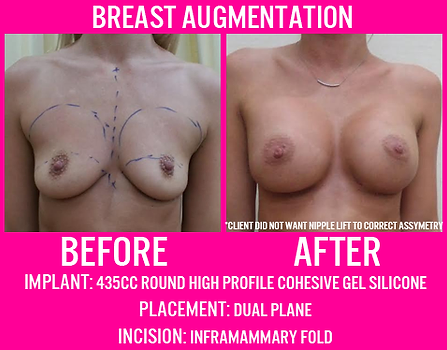 435CC Round High Profile Gel - Breast Augmentation - Medi Makeovers