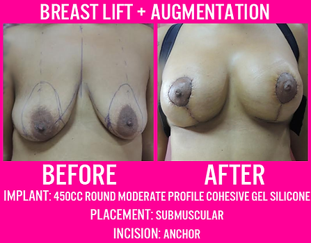 450CC Submuscular Breast lift augmentation