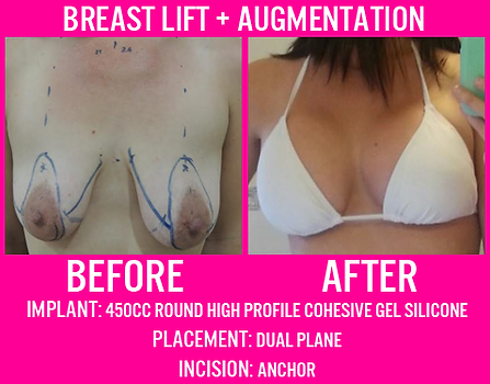 450CC Submuscular Breast lift augmentation 2