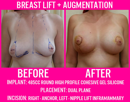 485CC High Profile Gel - Breast Lift and Breast Augmentation - Medi Makeovers