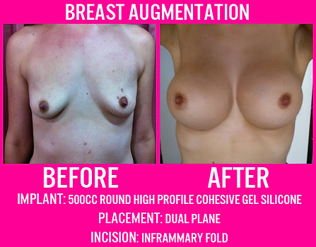 500CC High Profile - Breast Augmentation - Medi Makeovers