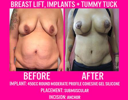 Breast Lift + Breast Implants + Tummy Tuck 2