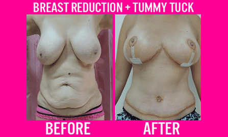 Breast Reduction and Tummy Tuck - Medi Makeovers