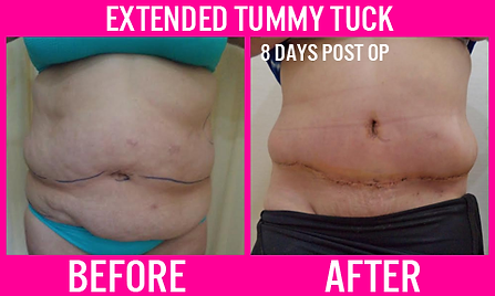 Extended Tummy Tuck - 8 days