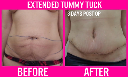 Extended Tummy Tuck - Medi Makeovers