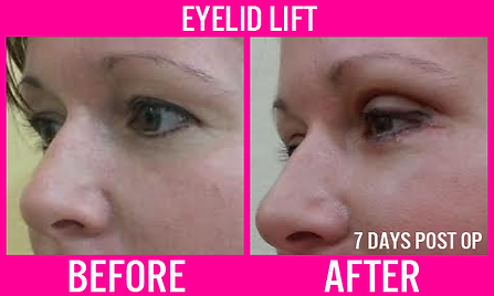 Eyelid lift - Medi Makeovers