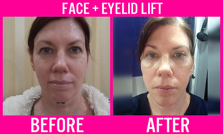 Face and eyelid lift