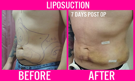 Liposuction Male