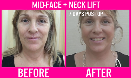 Mid-face and Neck lift