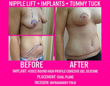 Nipple lift + Implant + Tummy Tuck
