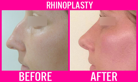 Rhinoplasty - Medi Makeovers