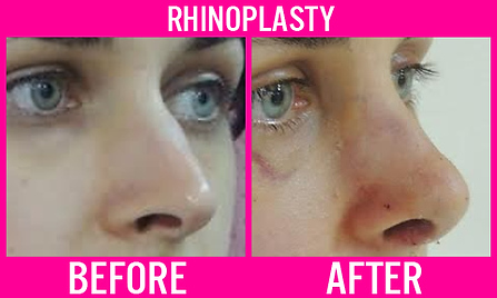 Rhinoplasty 6