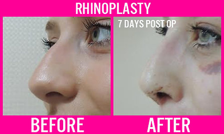 Rhinoplasty 8