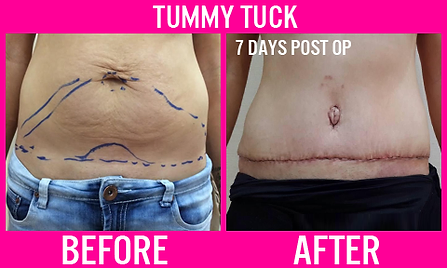 Tummy Tuck - Medi Makeovers