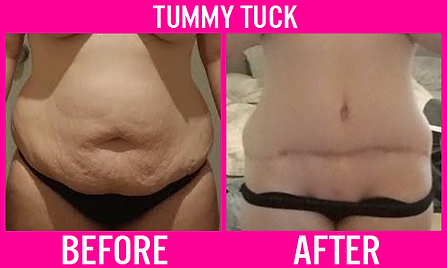 Tummy Tuck 2