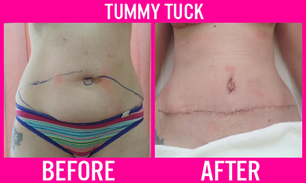 Tummy Tuck 3