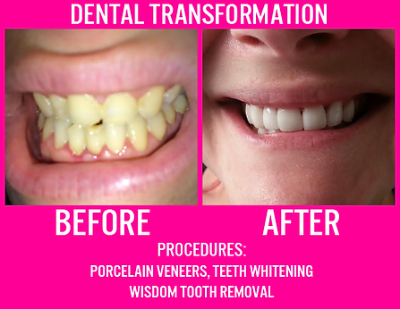 Veneers, Whitening, and Wisdom tooth extraction
